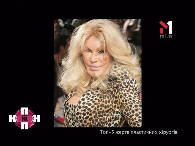 Топ 5 жертв пластичних хірургів